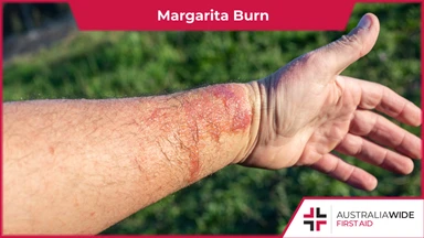 A man's arm with a superficial burn 